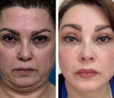 بهبود بافت پوست / افزایش استحکام پوست / سفت کردن پوست و رفع چین و چروک / افزایش آبرسانی پوست و جلوگیری از ایجاد چین و چروک